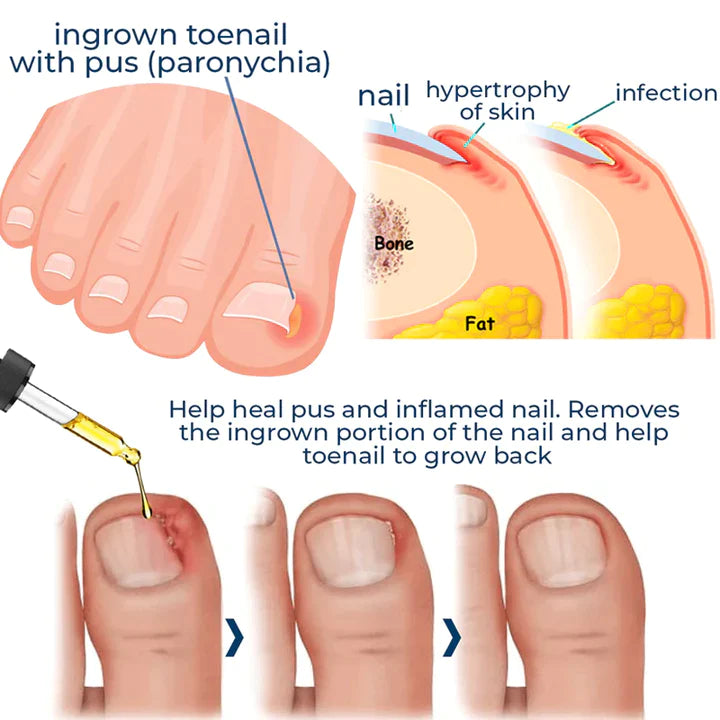 German ToenailPlus™ Anti Paronychia Relief Oil